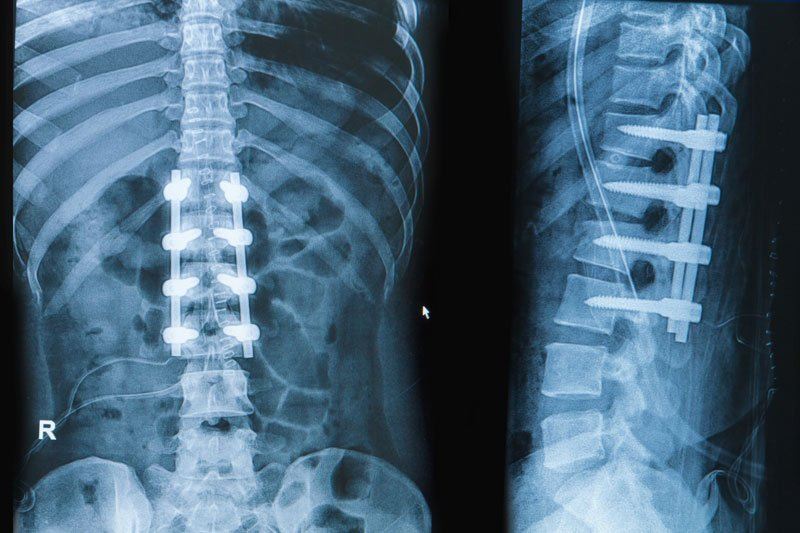 spinal fusion.1908261331550