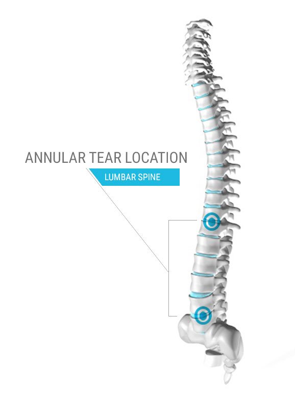 Annular Tear Location Diagram