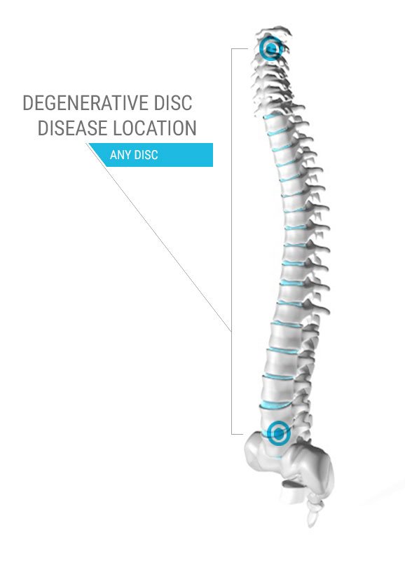 Degenerative Disc Disease Location Diagram 