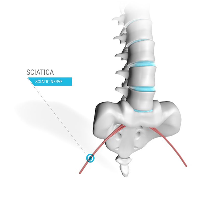 What Causes a Pinched Nerve in the Hip & How to Treat It?  Pinched nerve,  Back pain remedies, Sciatic nerve pain relief