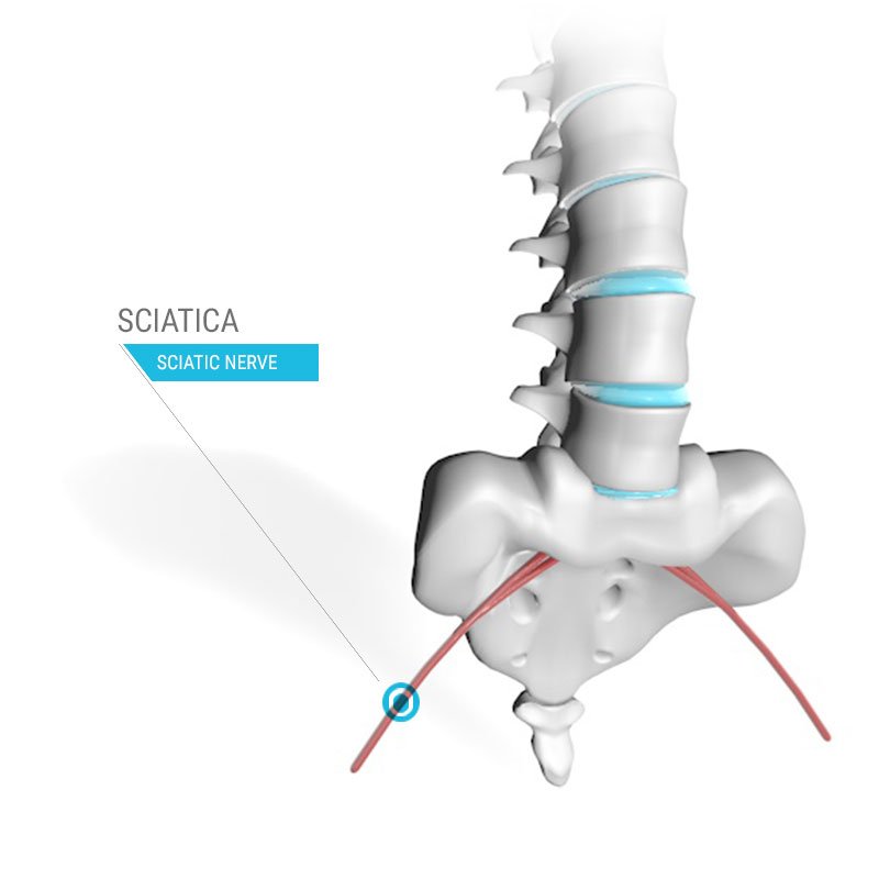 Spine diagram showing sciatica